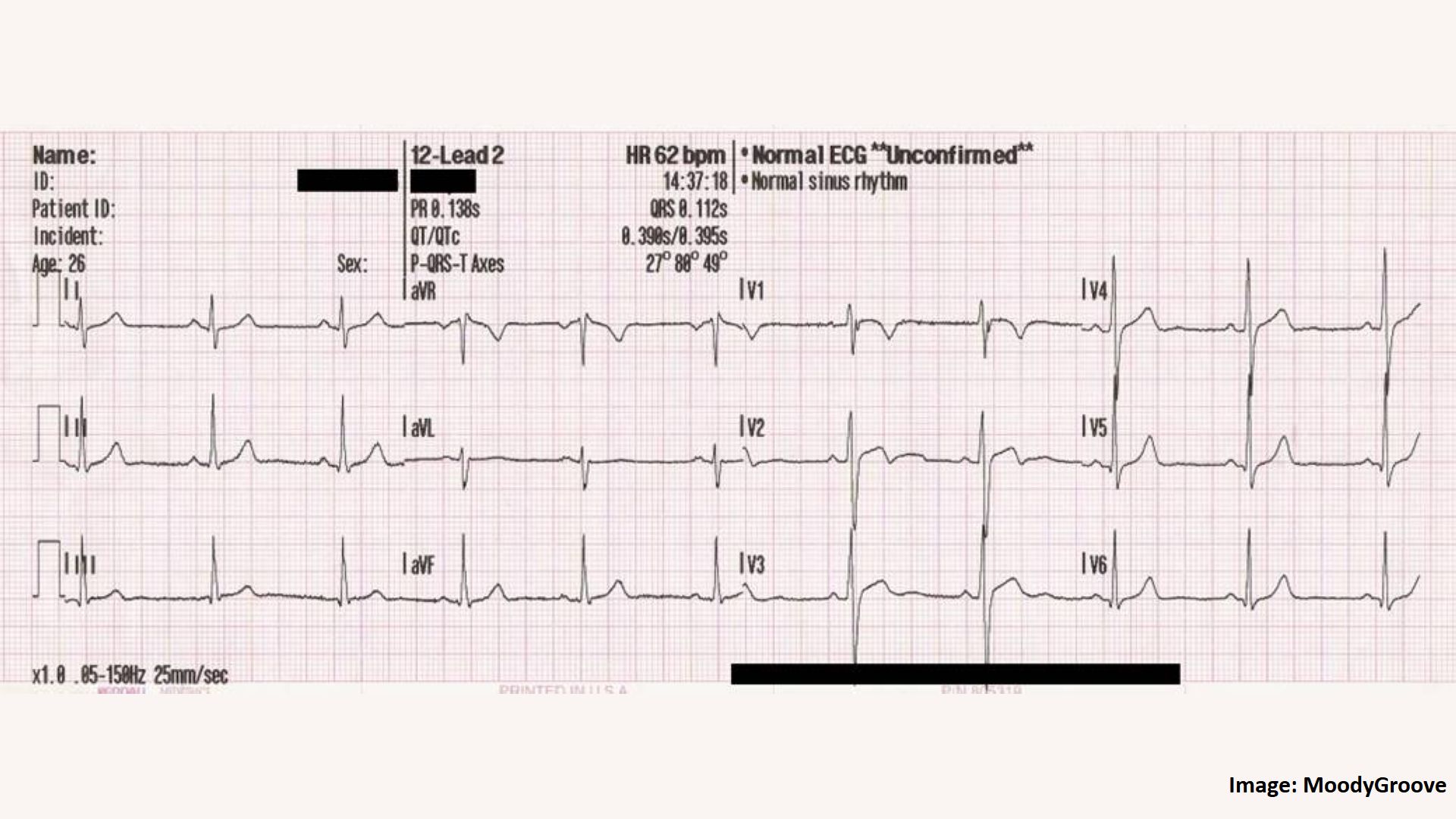 What's an Electrocardiogram?