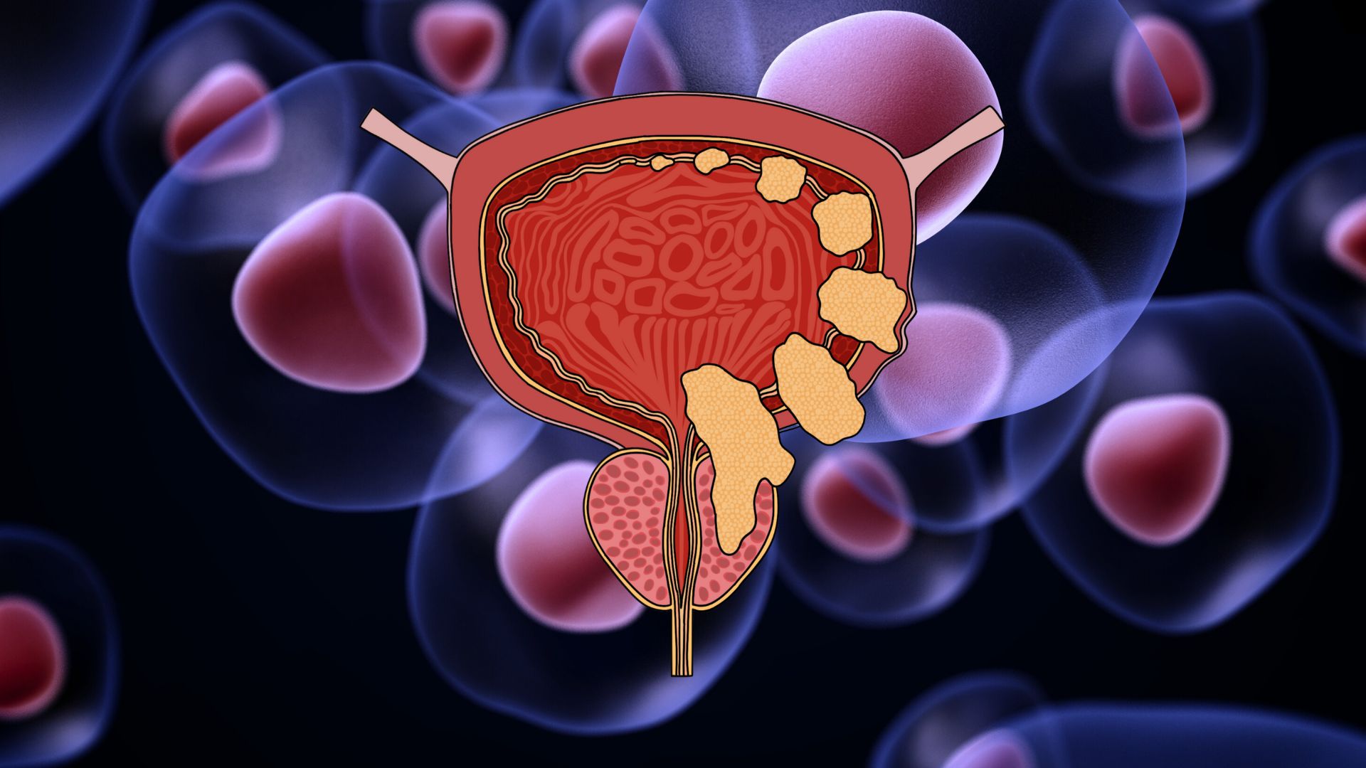 New study identifies cellular ‘self-eating’ markers to help track bladder cancer