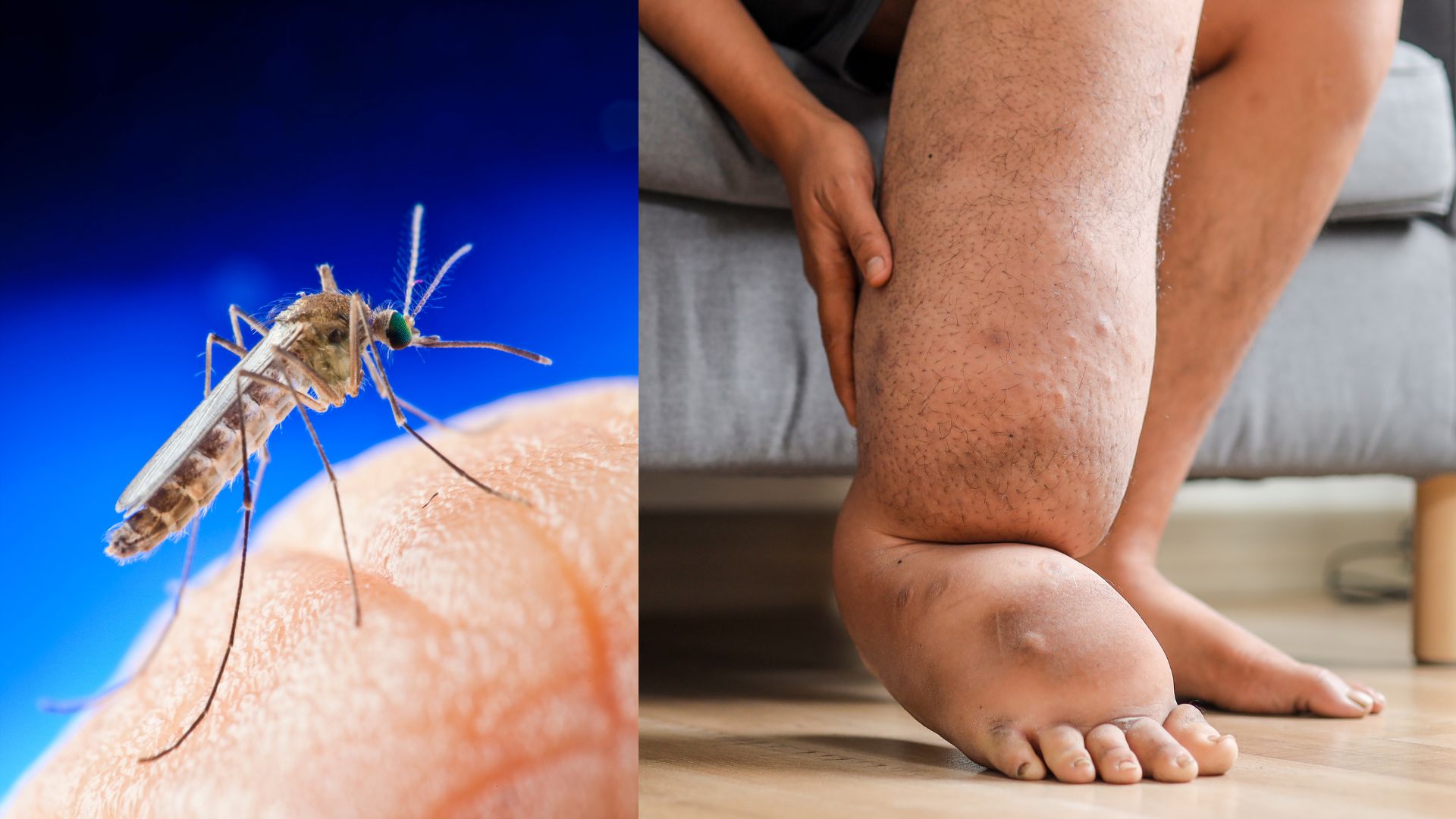 Fighting Filariasis: New ICMR Study Reveals Top Strategies for Disease Detection