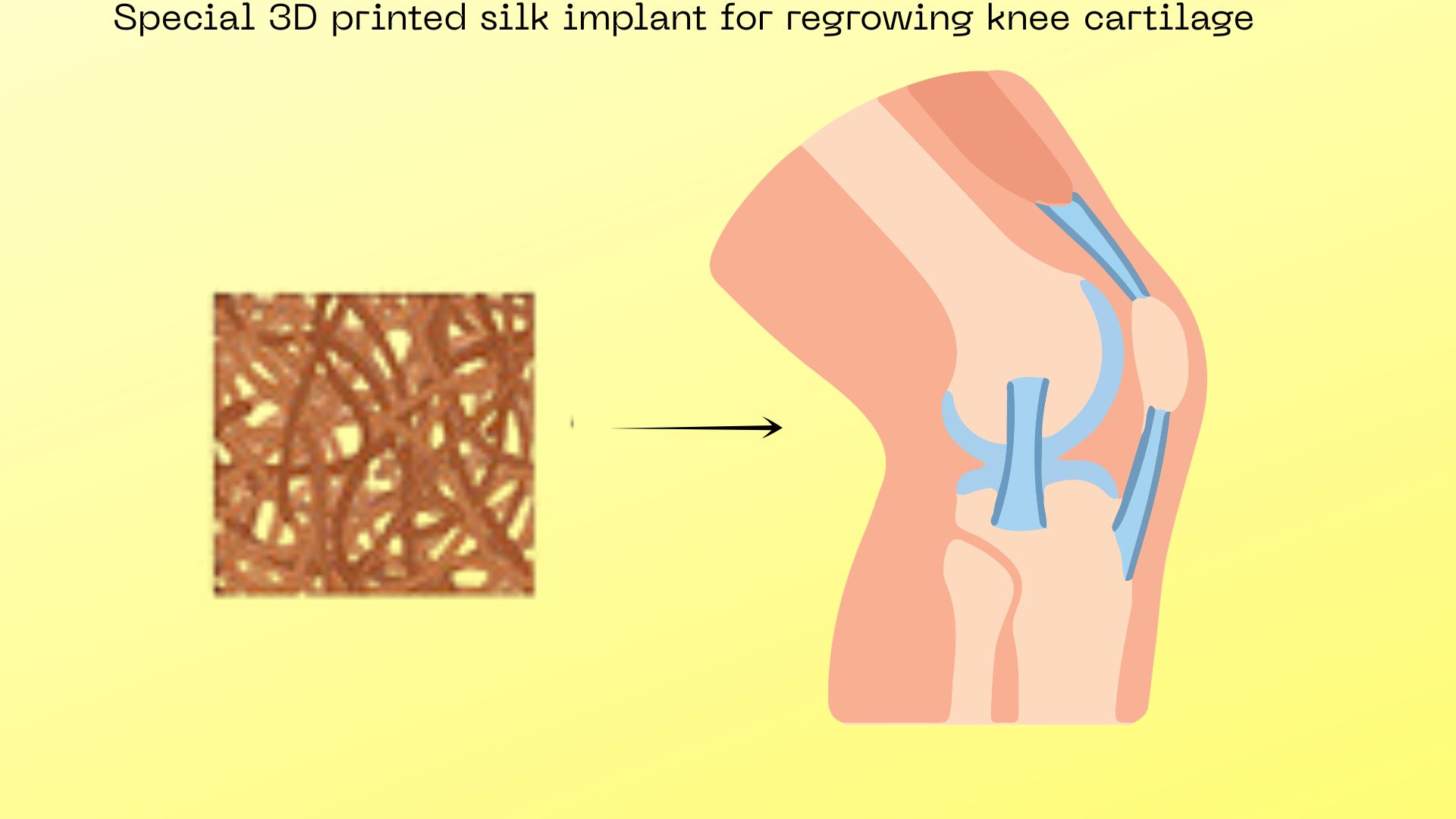 3D-printed silk implant successfully regrows knee cartilage in rats